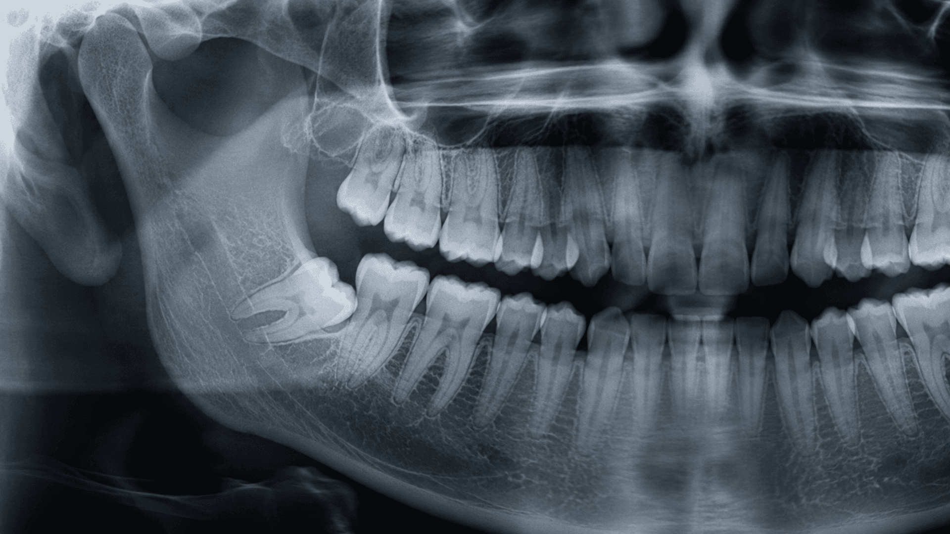 Wisdom Teeth Removal San Antonio